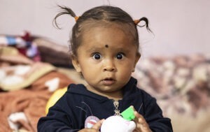 Help children like 1-year-old Mausam in Nepal receive life-changing surgery and rehabilitation for clubfoot.